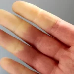 Ce sugerează frigul constant sau mâinile reci despre sănătatea ta