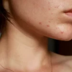 Alimente de evitat dacă urmezi un tratament pentru acnee