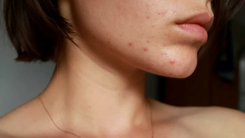 Alimente de evitat dacă urmezi un tratament pentru acnee