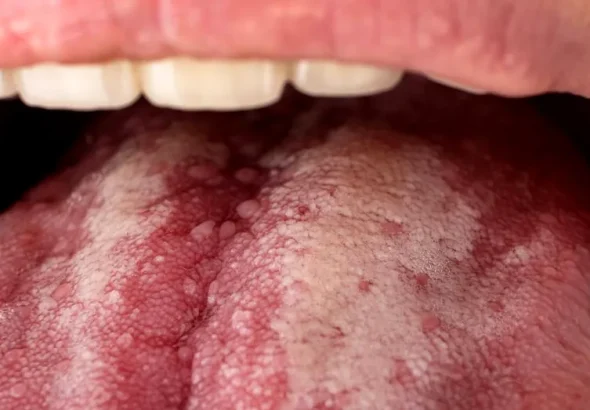 Cum afectează refluxul acidului gastric sănătatea dinților