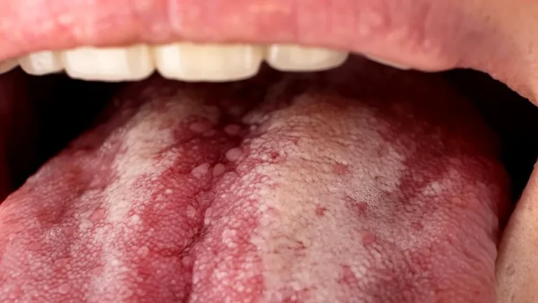 Cum afectează refluxul acidului gastric sănătatea dinților