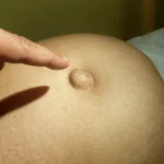 Umflătura de lângă buric pe care nu ar trebui să o ignori. Poate fi primul semn al unei hernii