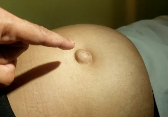 Umflătura de lângă buric pe care nu ar trebui să o ignori. Poate fi primul semn al unei hernii