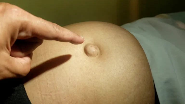 Umflătura de lângă buric pe care nu ar trebui să o ignori. Poate fi primul semn al unei hernii