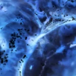 Inteligența artificială ar putea semnala riscul de cancer pancreatic cu ani înainte de diagnostic